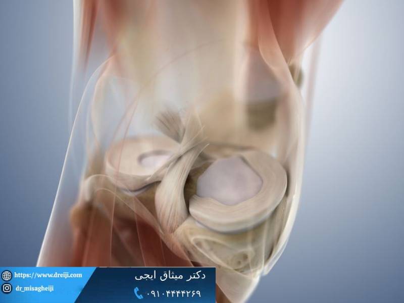 types-of-meniscus-tears-1